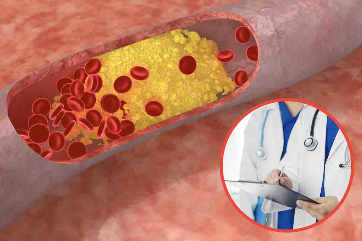 Colesterolo come abbassarlo in una settimana