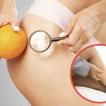 accumulo gambe cellulite lipedema perché fare attenzione