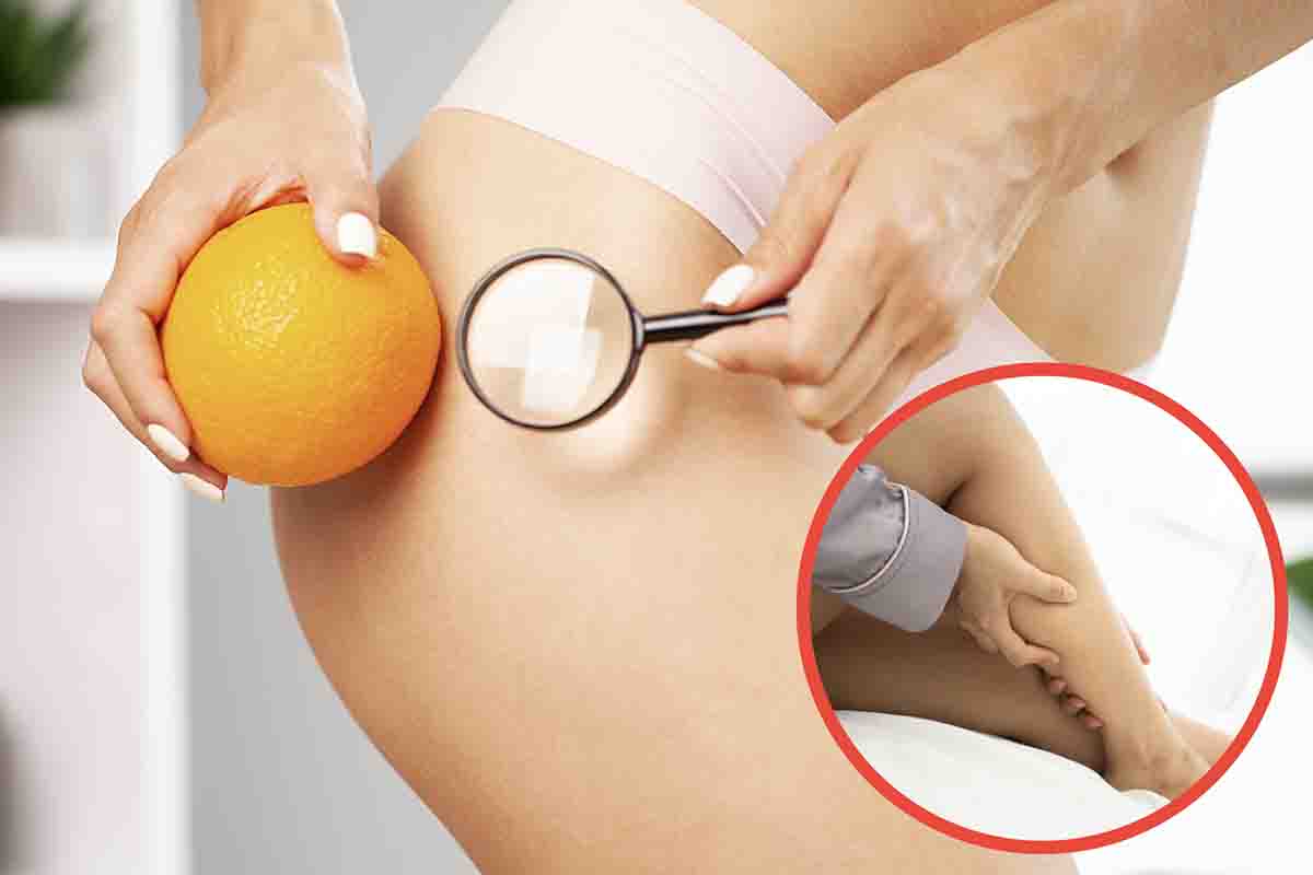 accumulo gambe cellulite lipedema perché fare attenzione